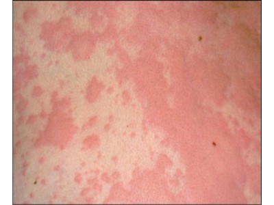 CON GÁI TÔI 4 TUỔI HẾT BỆNH MỀ ĐAY NHỜ DẦU HẠT NHO