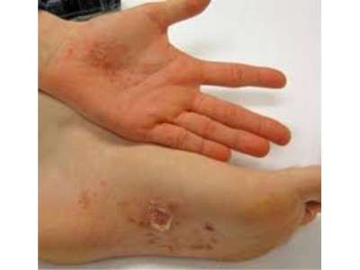 HẾT CHÀM VỚI DẦU HẠT NHO