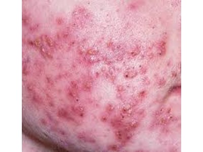 MỤN TRỨNG CÁ VÀ CÁCH CHĂM SÓC DA BỊ MỤN